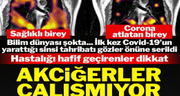 Covid-19’u hafif geçirenlerin akciğerlerindeki gizli hasar ortaya çıktı