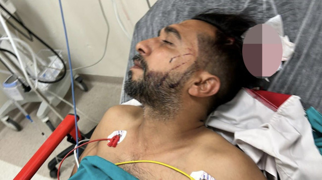 ADANA’DA DÖNER USTASI, İŞ YERİNDE BAŞINA İSABET EDEN YORGUN MERMİYLE YARALANDI